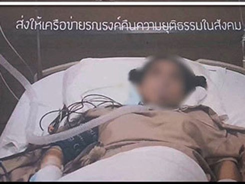 Phẫu thuật gọt cằm và cắt mí, cô gái trẻ hôn mê 5 tháng chưa tỉnh