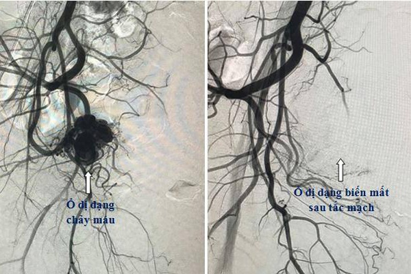 Người phụ nữ tuôn máu ồ ạt ngày đèn đỏ phải nhập viện vì lý do không ngờ-1