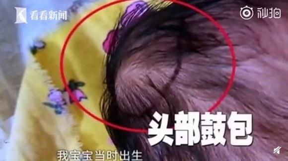 Y tá ngủ gật trong lúc bế, bé trai sơ sinh chấn thương nặng nề vì đập đầu xuống đất-1