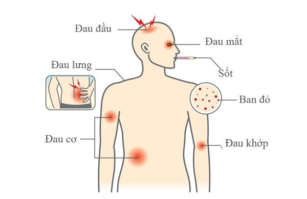 Triệu chứng dễ nhầm sốt xuất huyết và sốt thường, để lâu nguy hiểm tính mạng-2