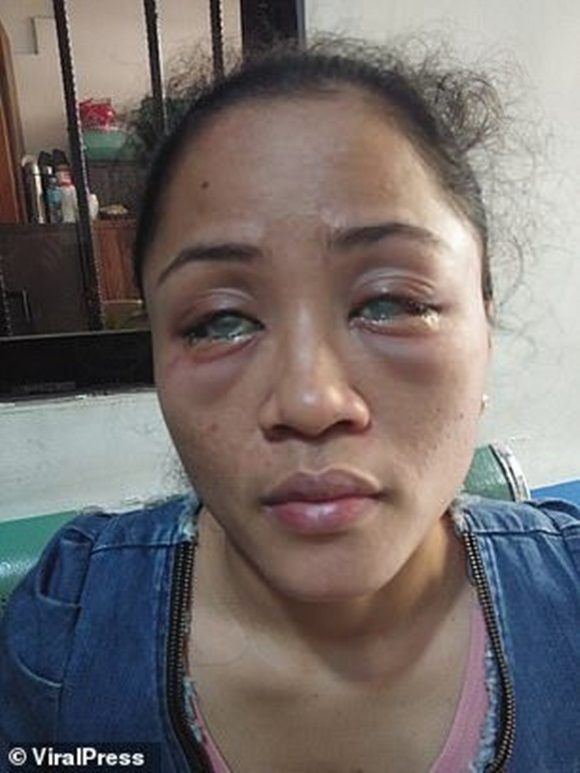 Phát hiện bạn trai có người tình đồng tính bên ngoài, cô gái chưa hết đau lòng còn bị đánh ghen ngược, đối mặt nguy cơ mù cả hai mắt-1