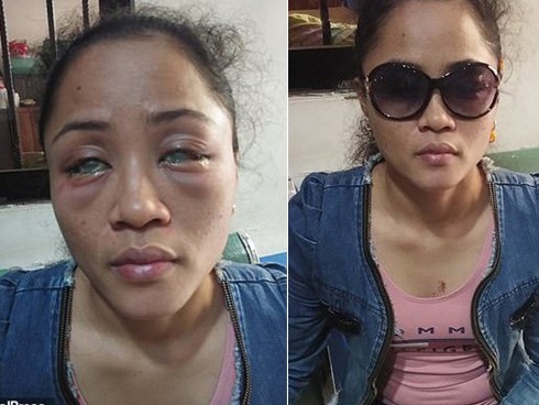 Phát hiện bạn trai có người tình đồng tính bên ngoài, cô gái chưa hết đau lòng còn bị đánh ghen ngược, đối mặt nguy cơ mù cả hai mắt