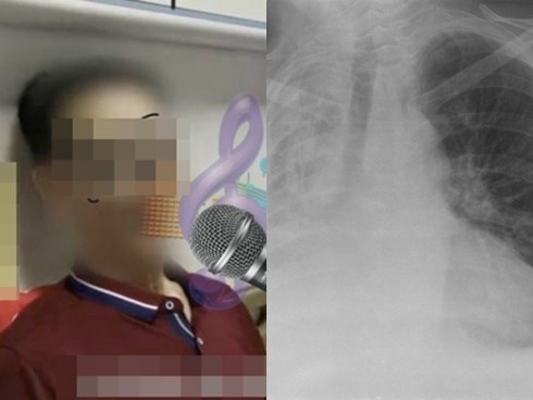 Cụ ông 65 tuổi bị xẹp phổi suýt chết sau khi hát karaoke liền tù tì 10 bài giọng cao