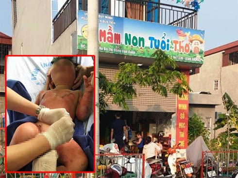 Cô giáo đốt cồn dạy phòng chống cháy nổ, 3 trẻ mầm non bị bỏng
