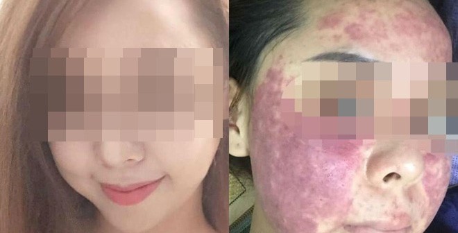 Kem trắng da cấp tốc” trộn bằng chậu, bán theo cân: Nếu không sớm sáng mắt” chị em dễ lĩnh hậu quả ung thư da-3