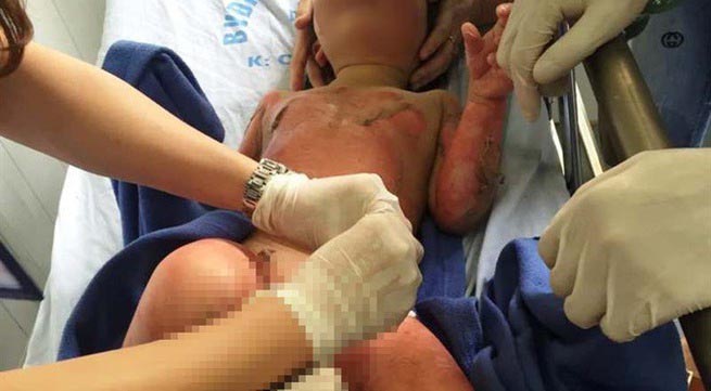 Diễn biến mới vụ 3 trẻ mầm non bỏng nặng vì cô giáo đốt cồn dạy kỹ năng... phòng cháy-1