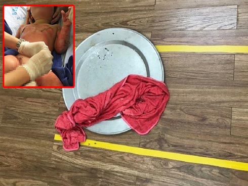Sức khỏe 3 trẻ mầm non bị bỏng do cô giáo đốt cồn dạy học: Thông tin mới nhất-2