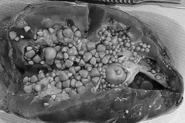 BV Việt Đức cảnh báo, nhiều người phải cắt thận vì lười uống nước-2