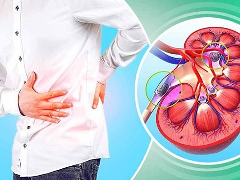 BV Việt Đức cảnh báo, nhiều người phải cắt thận vì lười uống nước