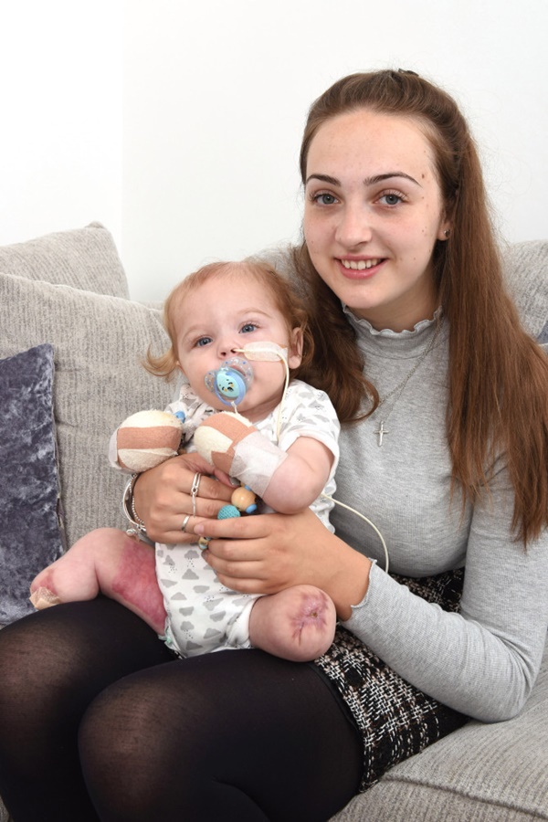 Bé trai 11 tháng rụng hết tay, chân sau 2 ngày viêm họng-3