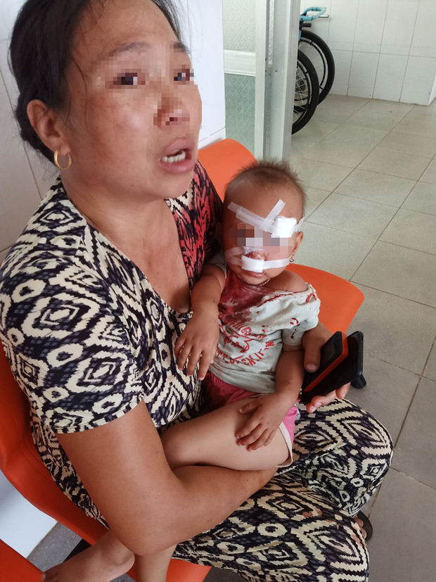 Mẹ bé gái bị cha ruột ném ly vào mặt, khâu 12 mũi: Lúc 13 tháng, con bé cũng bị ném vật cứng làm chấn thương sọ não-1