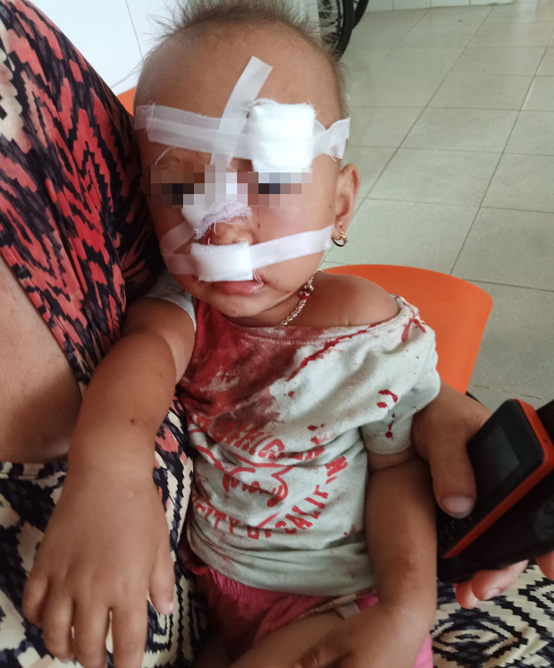 Mẹ bé gái bị cha ruột ném ly vào mặt, khâu 12 mũi: Lúc 13 tháng, con bé cũng bị ném vật cứng làm chấn thương sọ não-2