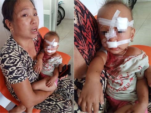 Mẹ bé gái bị cha ruột ném ly vào mặt, khâu 12 mũi: