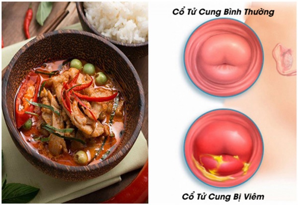 5 thực phẩm nuôi khối u xơ lớn mỗi ngày, là mối nguy hại với tử cung-1