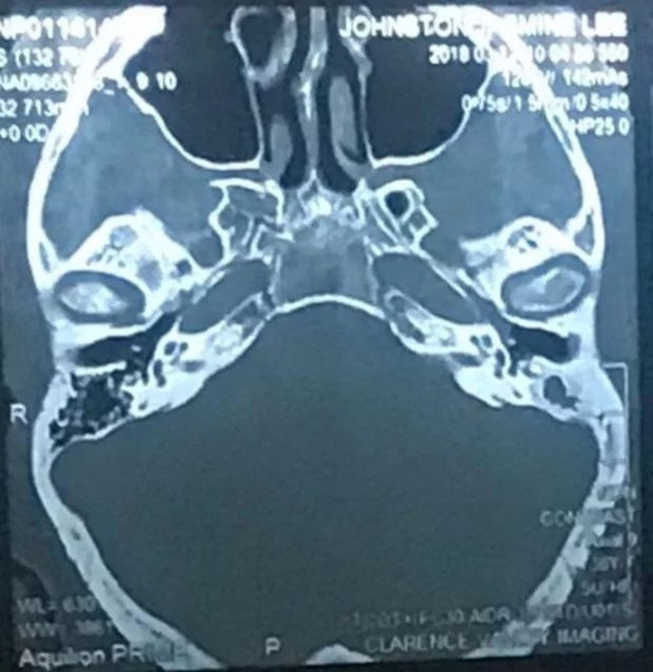 Cảnh báo: Dùng tăm bông lấy ráy tai, người phụ nữ suýt bị nhiễm trùng não và có nguy cơ tử vong-2
