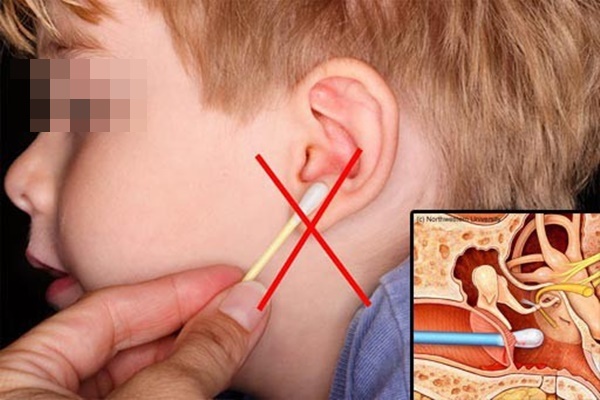 Cảnh báo: Dùng tăm bông lấy ráy tai, người phụ nữ suýt bị nhiễm trùng não và có nguy cơ tử vong-4