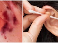 Cảnh báo: Dùng tăm bông lấy ráy tai, người phụ nữ suýt bị nhiễm trùng não và có nguy cơ tử vong