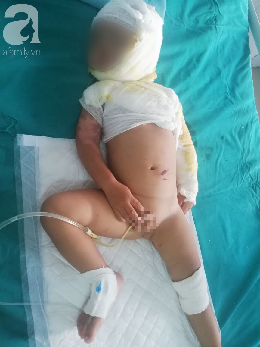 Vụ chồng tẩm xăng thiêu sống cả nhà vì vợ dỗ con không nín: Người mẹ hoảng loạn, bé trai 2 tuổi bị nhiễm trùng nặng-6