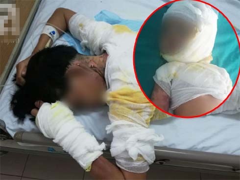 Vụ chồng tẩm xăng thiêu sống cả nhà vì vợ dỗ con không nín: Người mẹ hoảng loạn, bé trai 2 tuổi bị nhiễm trùng nặng