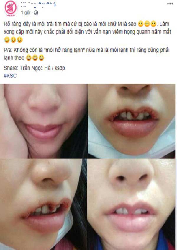 Ai bảo cứ môi trái tim là đẹp, cứ nhìn những ca thẩm mỹ này thì SÁNG MẮT NGAY-6