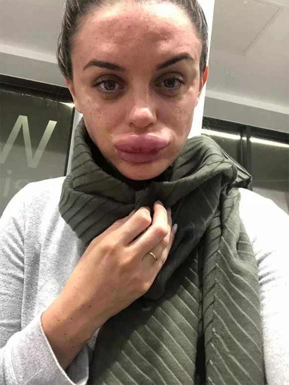 Cô gái người Anh sưng vù môi, suýt hoại tử vì tiêm filler tại nhà-1