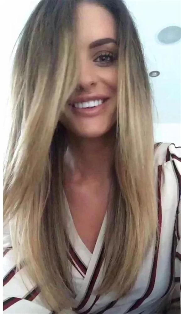 Cô gái người Anh sưng vù môi, suýt hoại tử vì tiêm filler tại nhà-2