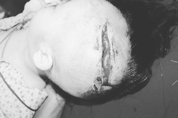 Bé gái 2 tuổi ở Hà Nội bị chó cắn rách đầu, lộ xương sọ-1