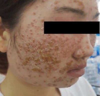 Chăm sóc da mặt theo những cách này, nhiều chị em khóc nghẹn vì da đóng vảy, sần sùi khó phục hồi-1