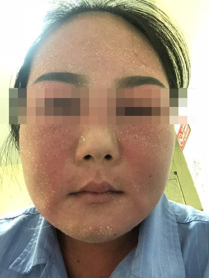 Chăm sóc da mặt theo những cách này, nhiều chị em khóc nghẹn vì da đóng vảy, sần sùi khó phục hồi-4