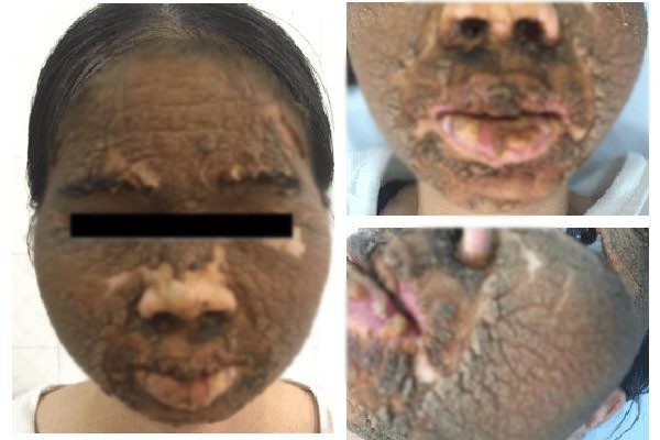 Chăm sóc da mặt theo những cách này, nhiều chị em khóc nghẹn vì da đóng vảy, sần sùi khó phục hồi-6