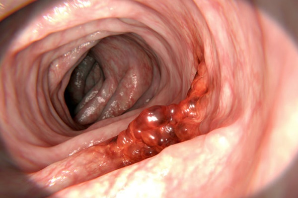 Người đàn ông đột ngột tử vong sau 2 tuần do bỏ qua dấu hiệu ung thư đơn giản-3