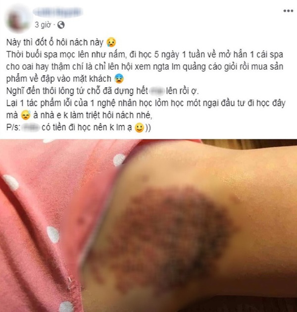 Rùng mình với hình ảnh đốt ổ hôi nách lan truyền trên mạng xã hội, nhìn thôi cũng thấy đau nhưng nhiều chị em vẫn cắn răng làm-1