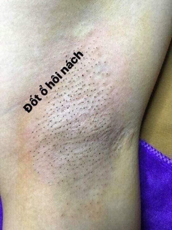 Rùng mình với hình ảnh đốt ổ hôi nách lan truyền trên mạng xã hội, nhìn thôi cũng thấy đau nhưng nhiều chị em vẫn cắn răng làm-4