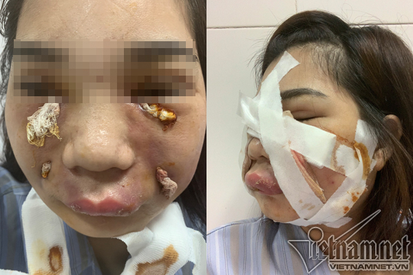 Cô gái xinh đẹp phải rạch mặt để nặn mủ do tiêm mỡ tự thân làm đẹp-2