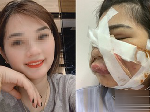 Cô gái xinh đẹp phải rạch mặt để nặn mủ do tiêm mỡ tự thân làm đẹp