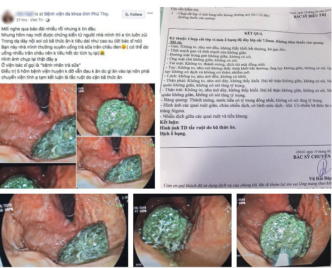 Bệnh viện đa khoa Phú Thọ tiếp nhận ca tắc ruột nguy hiểm, nghi do uống trà sữa liên tục-1