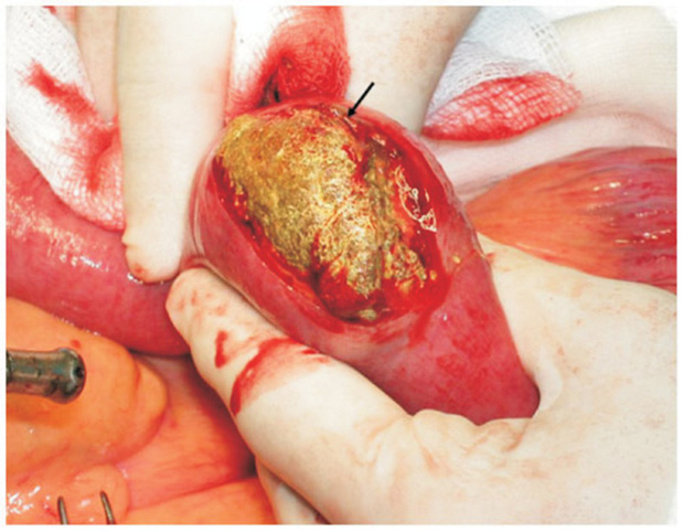 Bệnh viện đa khoa Phú Thọ tiếp nhận ca tắc ruột nguy hiểm, nghi do uống trà sữa liên tục-2