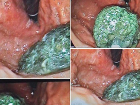 Người đàn ông bị tắc ruột sau nhiều ngày ăn lương khô vì mưa lũ-2