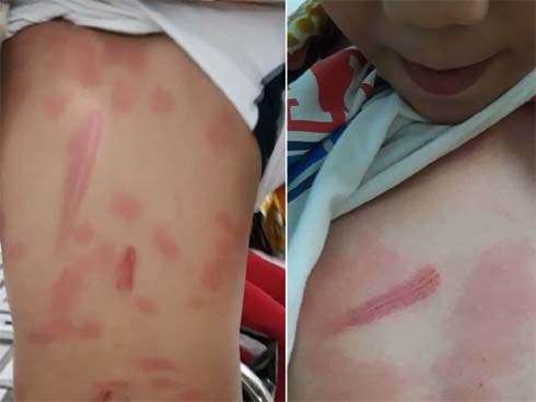 Bé trai ở Tiền Giang bị cô ruột đánh, chi chít vết thương trên người