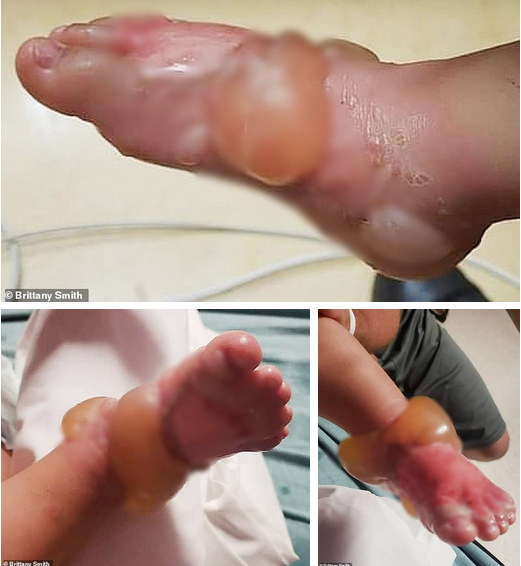 Buồn bực vô cớ, người phụ nữ nhúng chân cháu gái vào nước sôi cho hả giận, khiến cô bé bị bỏng nặng có nguy cơ phải cắt chân-3