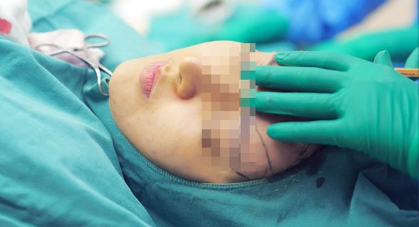 Muốn tiêm mỡ tự thân mà không bị rạch mặt để nặn mủ, chuyên gia khuyến cáo 5 điều quan trọng-4