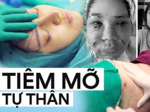 Làm đẹp bằng cách tiêm mỡ tự thân sẽ không trở thành nỗi ác mộng kinh hoàng nếu bạn nhớ 5 điều quan trọng này từ chuyên gia-5