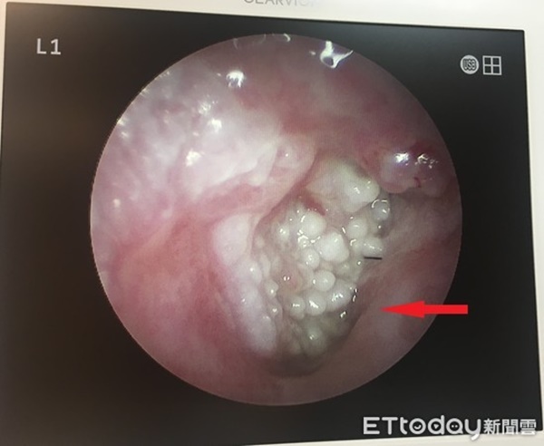 Sau 1 lần thư giãn ở quán cắt tóc, cụ ông khiến bác sĩ khiếp vía vì thấy thứ này trong tai-1