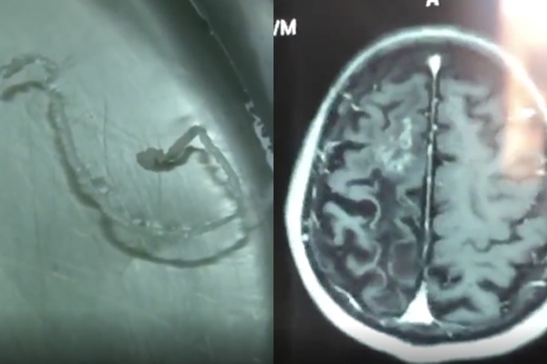 Người đàn ông đau đầu 30 năm, bác sĩ lôi ra sinh vật 10cm trong não-1