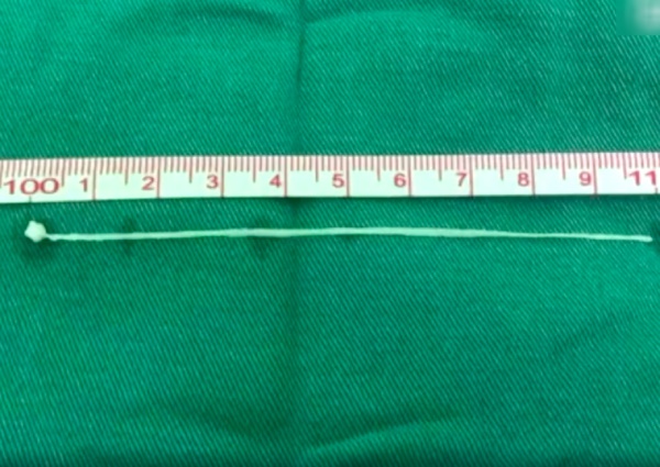 Người đàn ông đau đầu 30 năm, bác sĩ lôi ra sinh vật 10cm trong não-2