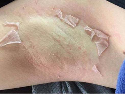 Tự ý lột da mặt để mong sở hữu làn da đẹp bằng những cách được đồn thổi trên MXH, nhiều chị em lĩnh hậu quả cay đắng với gương mặt tan nát”-6