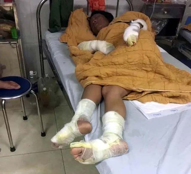 Thương tâm bé trai 7 tháng tuổi cùng cha mẹ bị bỏng nặng do hở gas lúc đun nấu-3