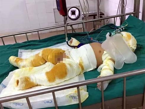 Thương tâm bé trai 7 tháng tuổi cùng cha mẹ bị bỏng nặng do hở gas lúc đun nấu