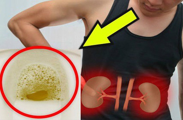 Cẩn thận với những triệu chứng kéo dài đang ngầm cảnh báo nguy cơ suy thận sắp xảy ra-4