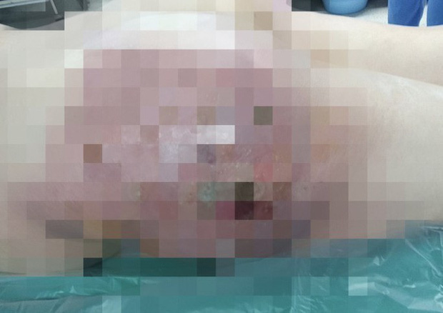 Vòng 3 biến dạng, hoại tử nghiêm trọng sau tiêm silicon-1